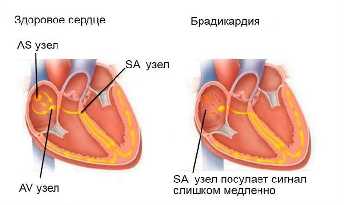 Синусовая брадикардия.